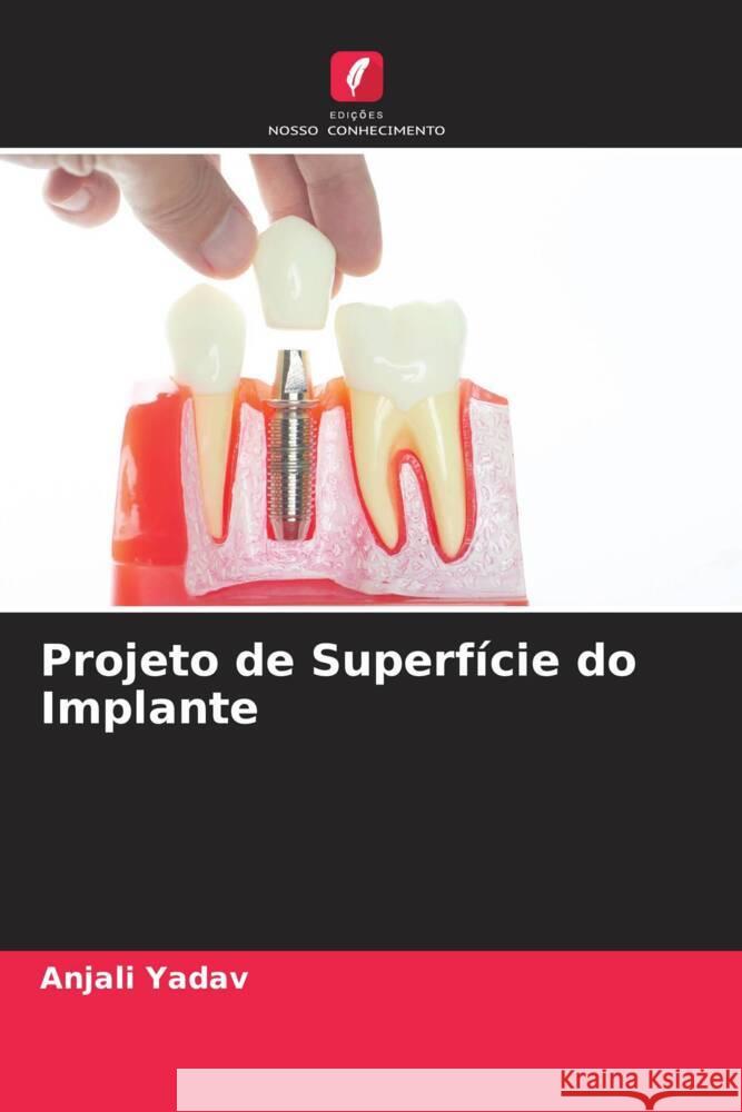 Projeto de Superfície do Implante Yadav, Anjali 9786204417813 Edições Nosso Conhecimento