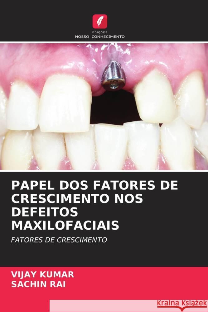 PAPEL DOS FATORES DE CRESCIMENTO NOS DEFEITOS MAXILOFACIAIS Kumar, Vijay, RAI, SACHIN 9786204438290 Edições Nosso Conhecimento