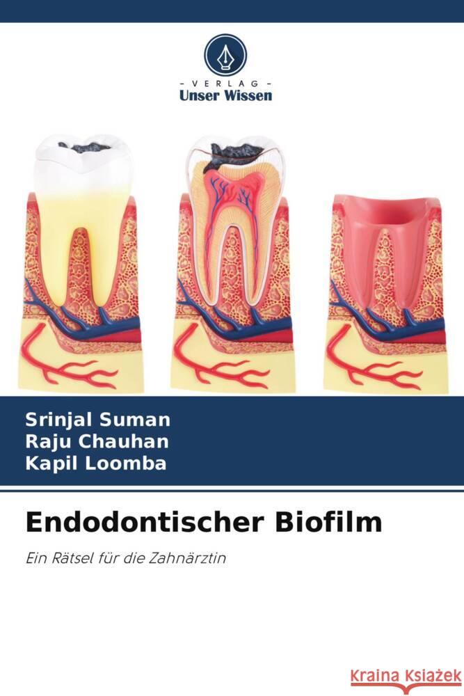 Endodontischer Biofilm Suman, Srinjal, Chauhan, Raju, Loomba, Kapil 9786204493688 Verlag Unser Wissen