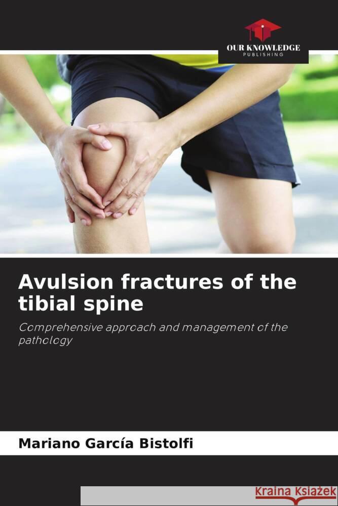 Avulsion fractures of the tibial spine García Bistolfi, Mariano 9786204504643 Our Knowledge Publishing