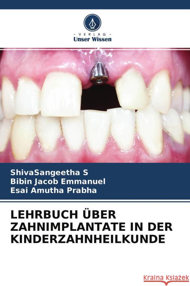 LEHRBUCH ÜBER ZAHNIMPLANTATE IN DER KINDERZAHNHEILKUNDE S, ShivaSangeetha, Emmanuel, Bibin Jacob, Prabha, Esai Amutha 9786204508979 Verlag Unser Wissen