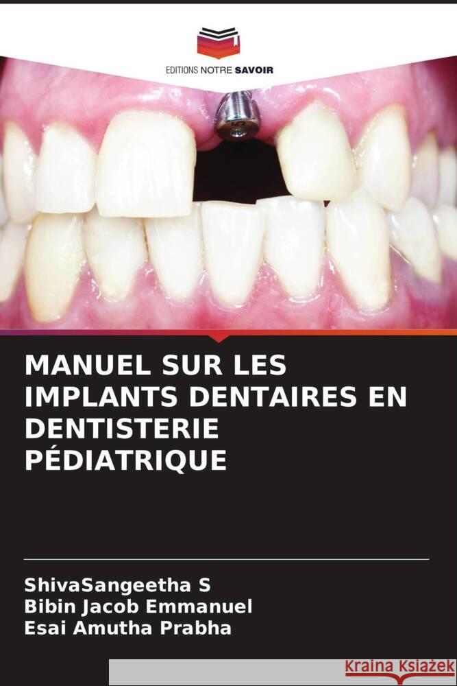 MANUEL SUR LES IMPLANTS DENTAIRES EN DENTISTERIE PÉDIATRIQUE S, ShivaSangeetha, Emmanuel, Bibin Jacob, Prabha, Esai Amutha 9786204508993 Editions Notre Savoir