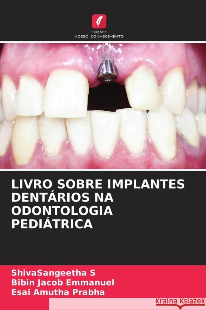 LIVRO SOBRE IMPLANTES DENTÁRIOS NA ODONTOLOGIA PEDIÁTRICA S, ShivaSangeetha, Emmanuel, Bibin Jacob, Prabha, Esai Amutha 9786204509013 Edições Nosso Conhecimento