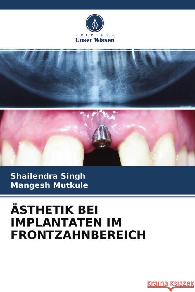 ÄSTHETIK BEI IMPLANTATEN IM FRONTZAHNBEREICH Singh, Shailendra, Mutkule, Mangesh 9786204526010 Verlag Unser Wissen