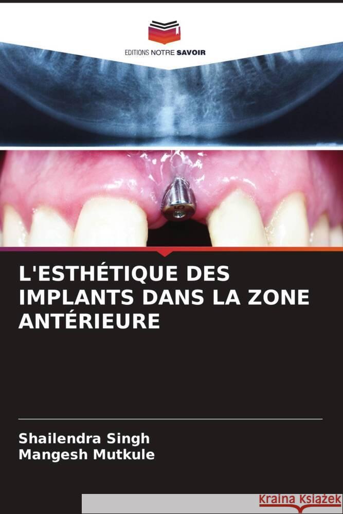 L'ESTHÉTIQUE DES IMPLANTS DANS LA ZONE ANTÉRIEURE Singh, Shailendra, Mutkule, Mangesh 9786204526096 Editions Notre Savoir