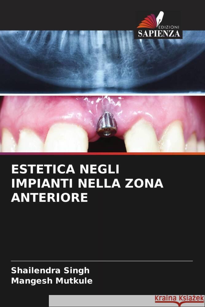 ESTETICA NEGLI IMPIANTI NELLA ZONA ANTERIORE Singh, Shailendra, Mutkule, Mangesh 9786204526102 Edizioni Sapienza