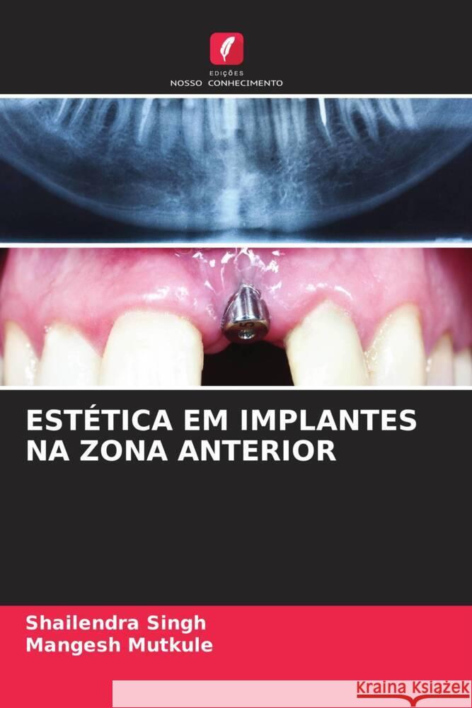 ESTÉTICA EM IMPLANTES NA ZONA ANTERIOR Singh, Shailendra, Mutkule, Mangesh 9786204526119 Edições Nosso Conhecimento