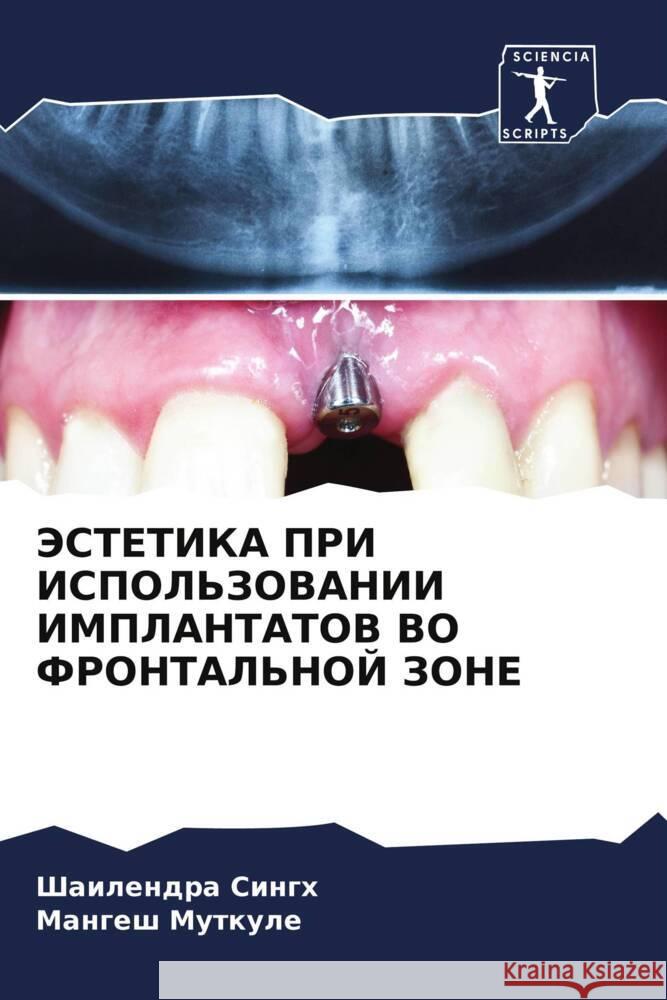 JeSTETIKA PRI ISPOL'ZOVANII IMPLANTATOV VO FRONTAL'NOJ ZONE Singh, Shailendra, Mutkule, Mangesh 9786204526126 Sciencia Scripts