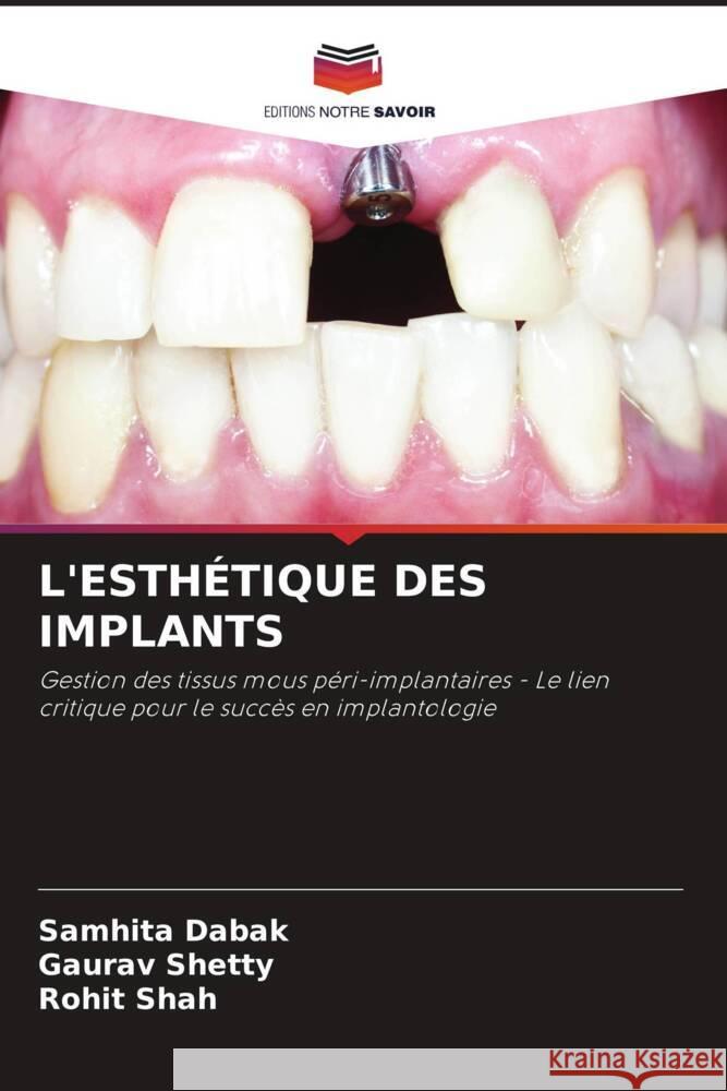 L'ESTHÉTIQUE DES IMPLANTS Dabak, Samhita, Shetty, Gaurav, Shah, Rohit 9786204560908