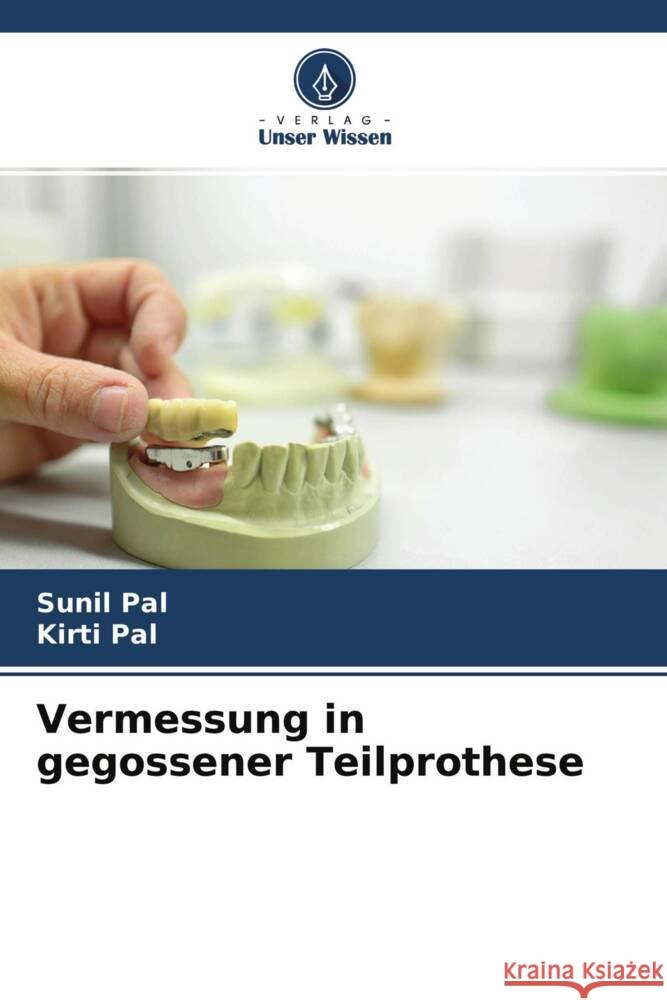 Vermessung in gegossener Teilprothese Pal, Sunil, Pal, Kirti 9786204562780 Verlag Unser Wissen