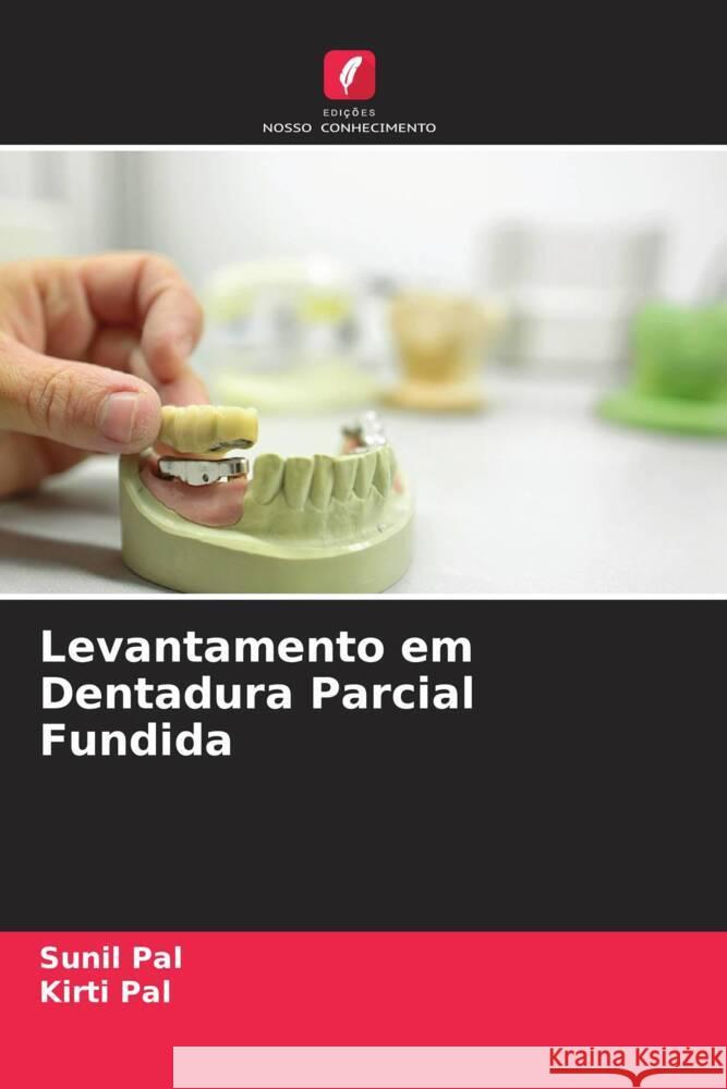 Levantamento em Dentadura Parcial Fundida Pal, Sunil, Pal, Kirti 9786204562827 Edições Nosso Conhecimento