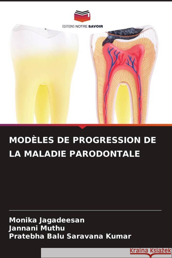 MODÈLES DE PROGRESSION DE LA MALADIE PARODONTALE Jagadeesan, Monika, Muthu, Jannani, Saravana Kumar, Pratebha Balu 9786204563725 Editions Notre Savoir