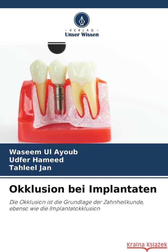 Okklusion bei Implantaten Ul Ayoub, Waseem, Hameed, Udfer, Jan, Tahleel 9786204641850