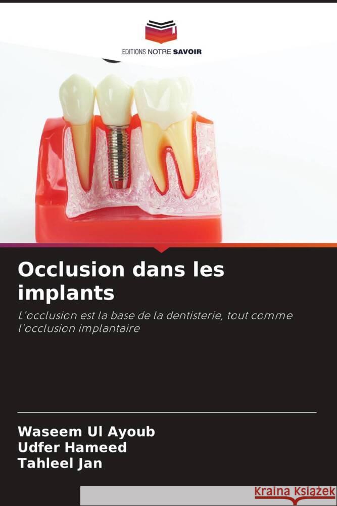 Occlusion dans les implants Ul Ayoub, Waseem, Hameed, Udfer, Jan, Tahleel 9786204641874