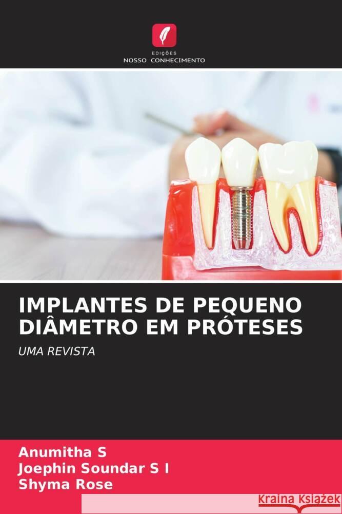 IMPLANTES DE PEQUENO DIÂMETRO EM PRÓTESES S, Anumitha, S I, Joephin Soundar, Rose, Shyma 9786204659107