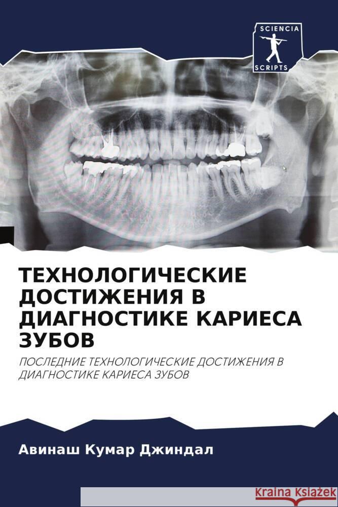 TEHNOLOGIChESKIE DOSTIZhENIYa V DIAGNOSTIKE KARIESA ZUBOV Kumar Dzhindal, Awinash 9786204660264