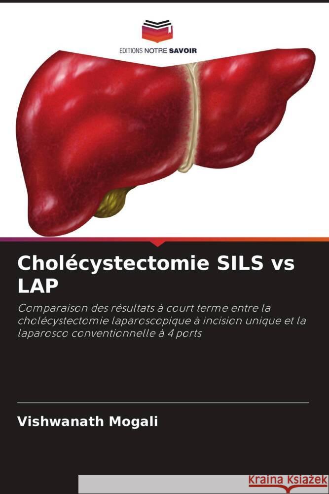 Cholécystectomie SILS vs LAP Mogali, Vishwanath 9786204673745 Editions Notre Savoir