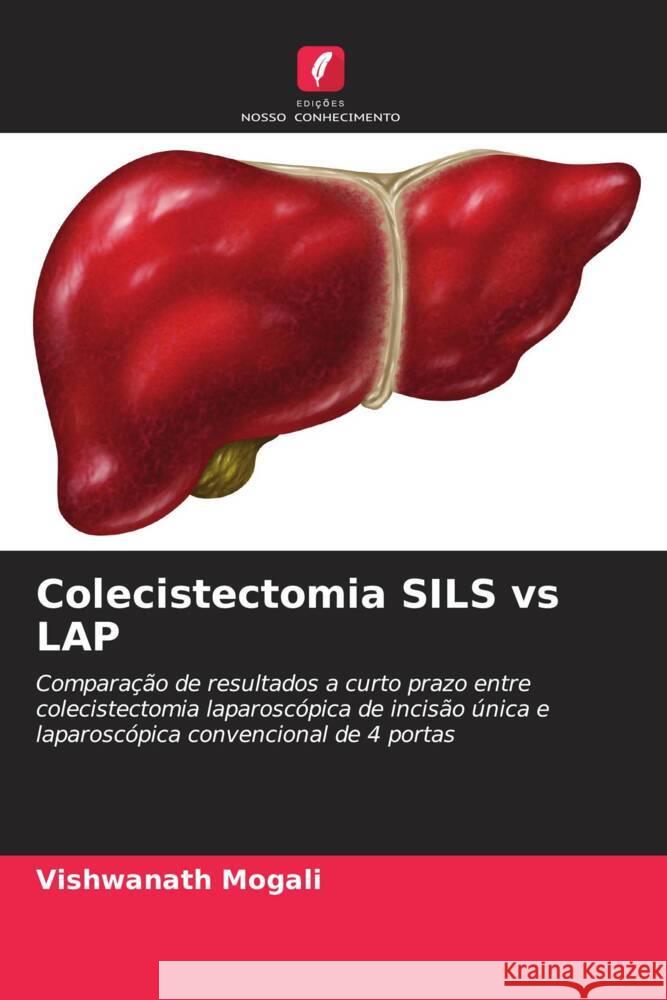 Colecistectomia SILS vs LAP Mogali, Vishwanath 9786204673783 Edições Nosso Conhecimento