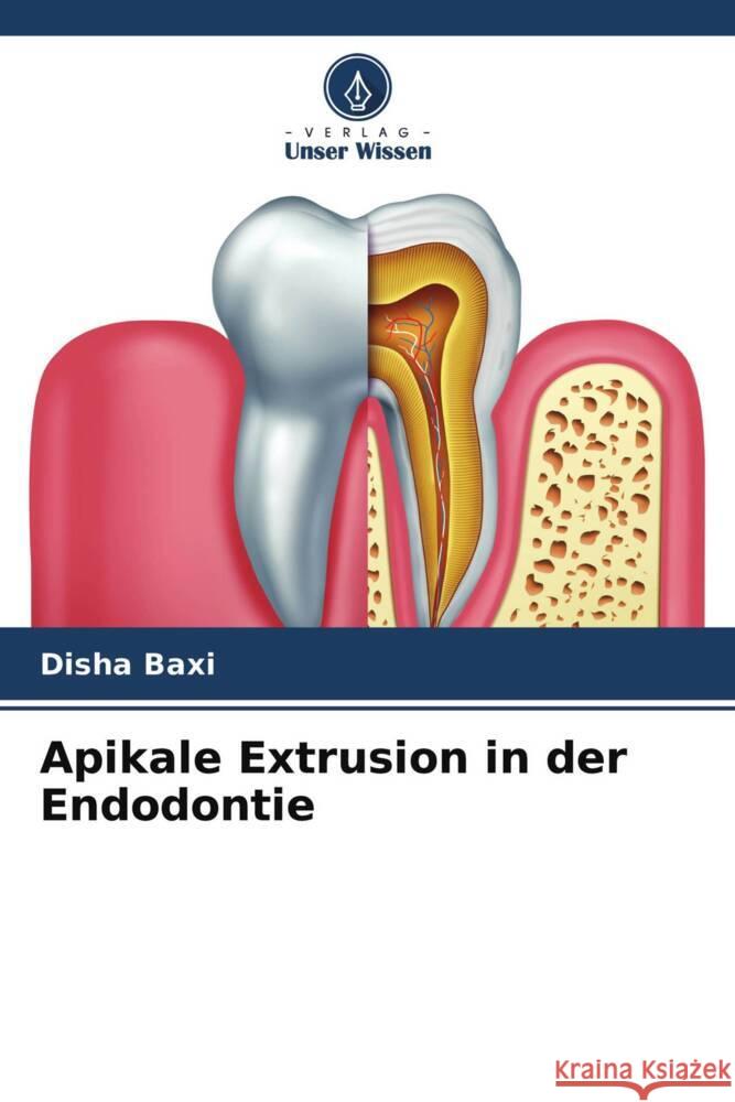 Apikale Extrusion in der Endodontie Baxi, Disha 9786204677750