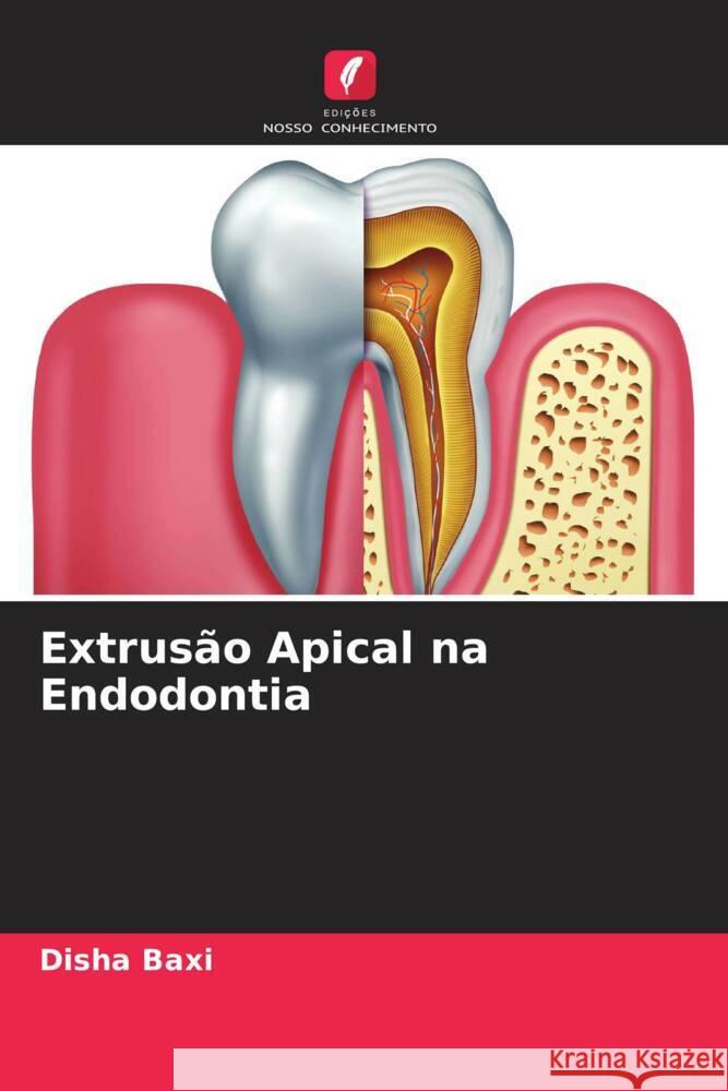 Extrusão Apical na Endodontia Baxi, Disha 9786204677811