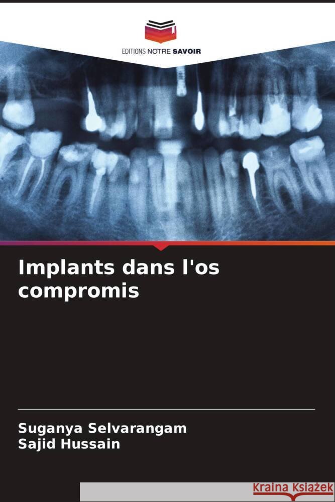 Implants dans l'os compromis Selvarangam, Suganya, Hussain, Sajid 9786204684253