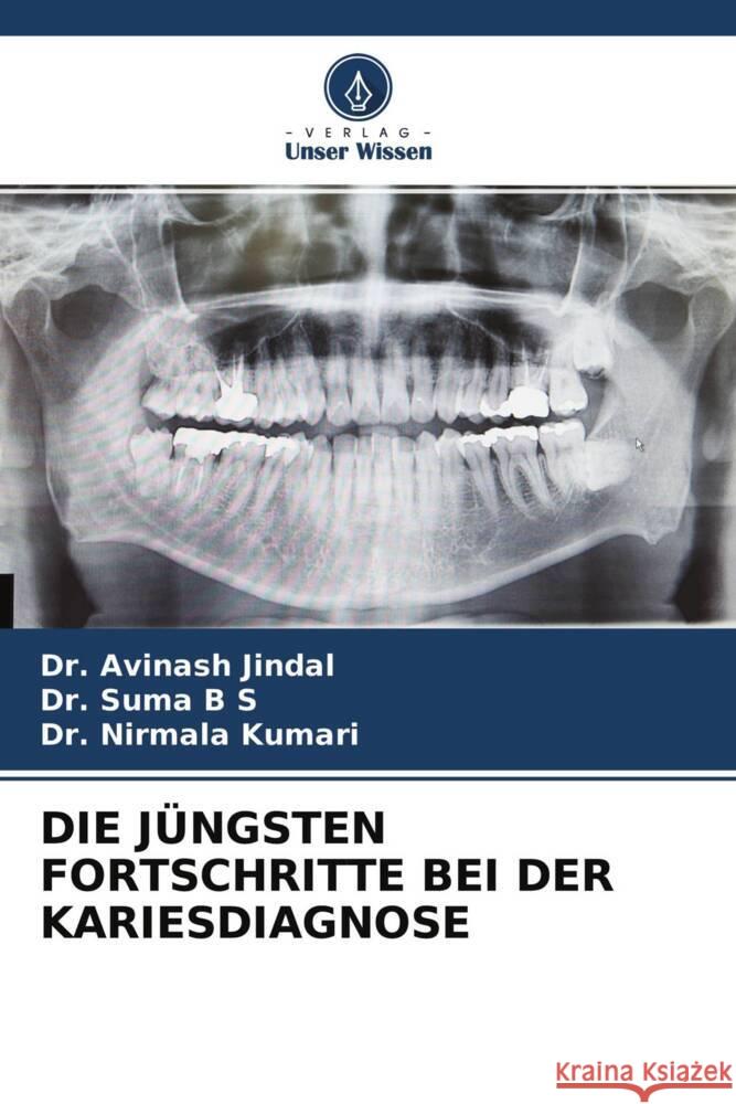 DIE JÜNGSTEN FORTSCHRITTE BEI DER KARIESDIAGNOSE Jindal, Dr. Avinash, B S, Dr. Suma, Kumari, Dr. Nirmala 9786204688213 Verlag Unser Wissen