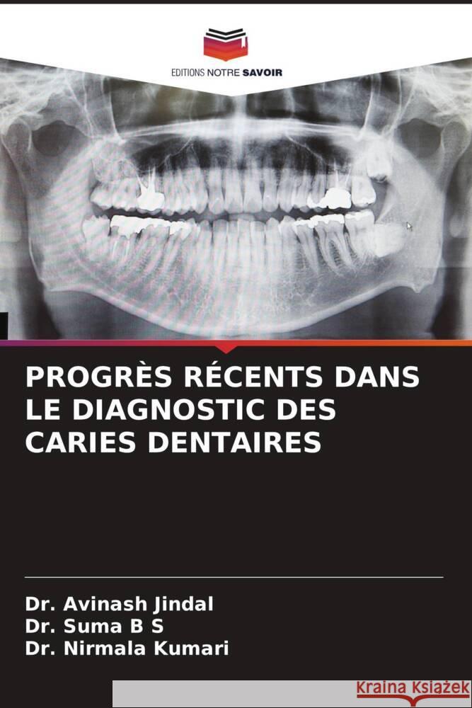 PROGRÈS RÉCENTS DANS LE DIAGNOSTIC DES CARIES DENTAIRES Jindal, Dr. Avinash, B S, Dr. Suma, Kumari, Dr. Nirmala 9786204688244 Editions Notre Savoir