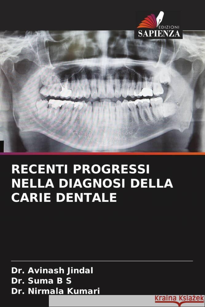 RECENTI PROGRESSI NELLA DIAGNOSI DELLA CARIE DENTALE Jindal, Dr. Avinash, B S, Dr. Suma, Kumari, Dr. Nirmala 9786204688268 Edizioni Sapienza