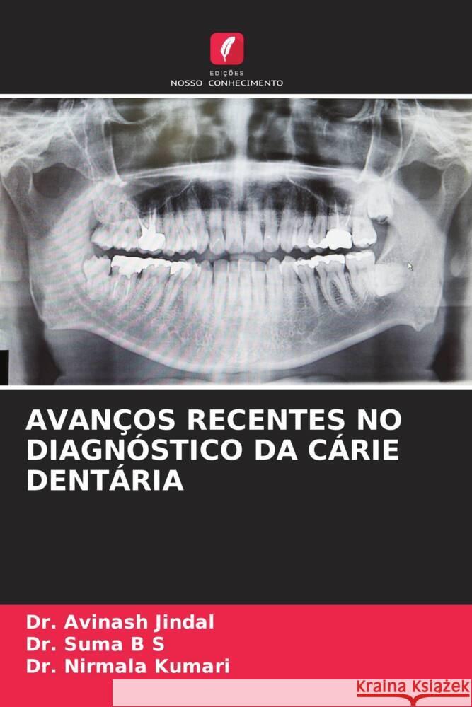 AVANÇOS RECENTES NO DIAGNÓSTICO DA CÁRIE DENTÁRIA Jindal, Dr. Avinash, B S, Dr. Suma, Kumari, Dr. Nirmala 9786204688282 Edições Nosso Conhecimento