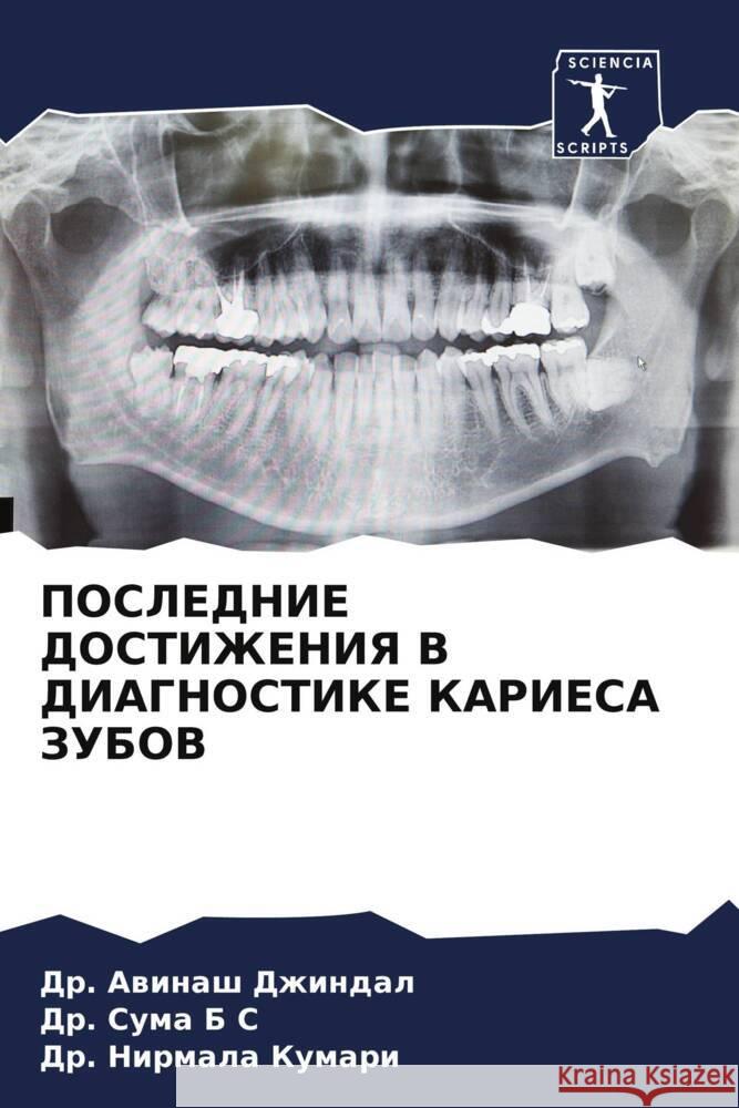 POSLEDNIE DOSTIZhENIYa V DIAGNOSTIKE KARIESA ZUBOV Dzhindal, Dr. Awinash, B S, Dr. Suma, Kumari, Dr. Nirmala 9786204688312 Sciencia Scripts