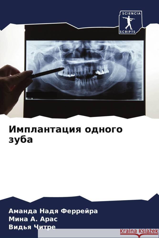 Implantaciq odnogo zuba Nadq Ferrejra, Amanda, A. Aras, Mina, Chitre, Vid'q 9786204707372 Sciencia Scripts