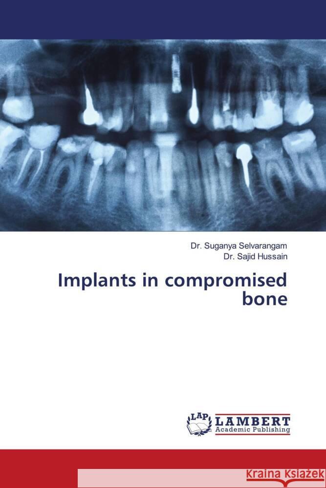 Implants in compromised bone Selvarangam, Dr. Suganya, Hussain, Dr. Sajid 9786204715254 LAP Lambert Academic Publishing