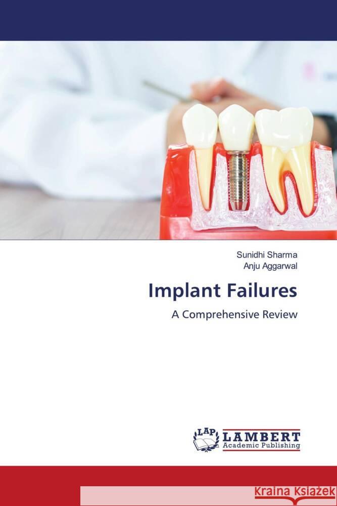 Implant Failures Sharma, Sunidhi, Aggarwal, Anju 9786204716459 LAP Lambert Academic Publishing