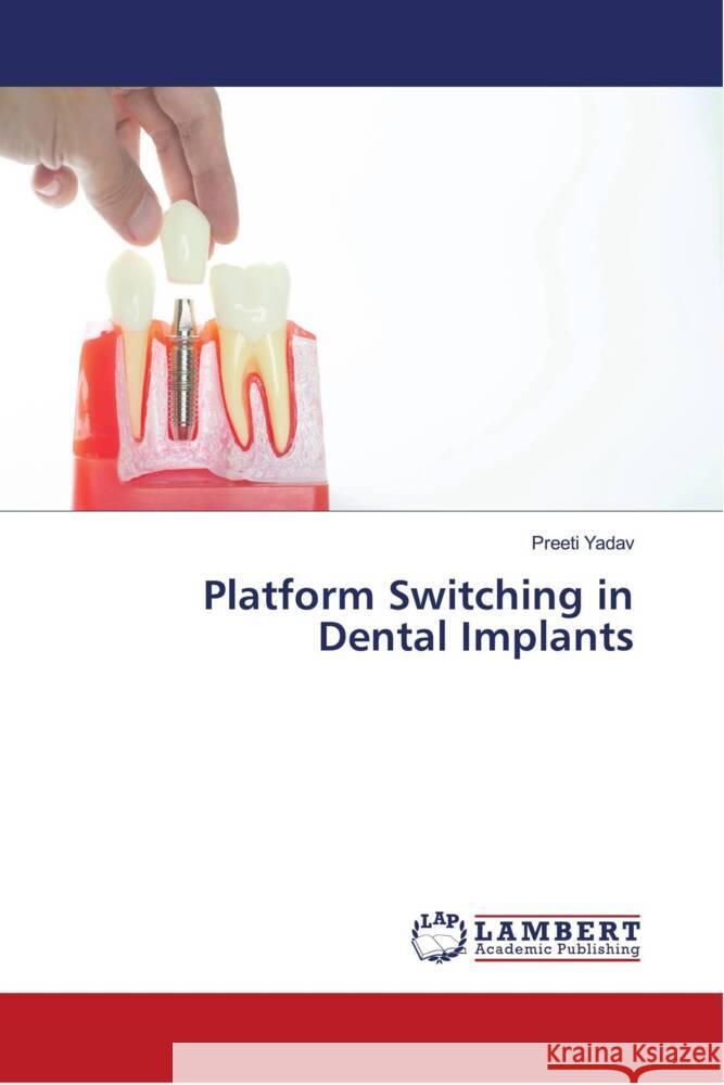 Platform Switching in Dental Implants Yadav, Preeti 9786204718590