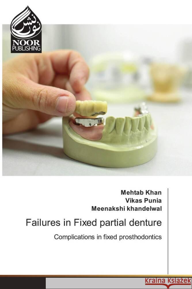 Failures in Fixed partial denture Khan, Mehtab, Punia, Vikas, Khandelwal, Meenakshi 9786204721415 Noor Publishing