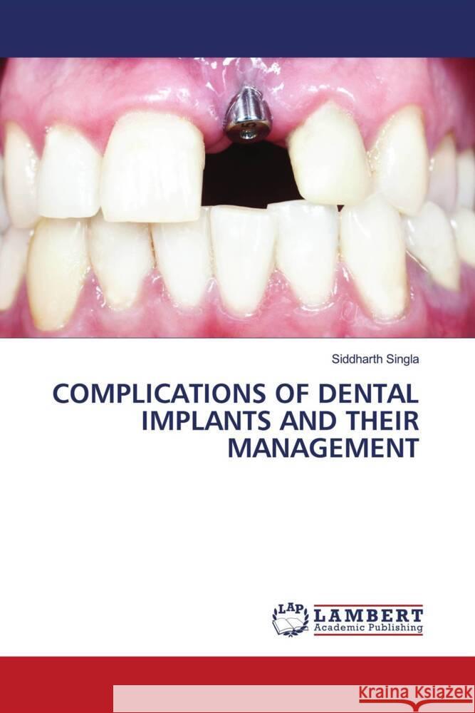 COMPLICATIONS OF DENTAL IMPLANTS AND THEIR MANAGEMENT Singla, Siddharth 9786204751726 LAP Lambert Academic Publishing