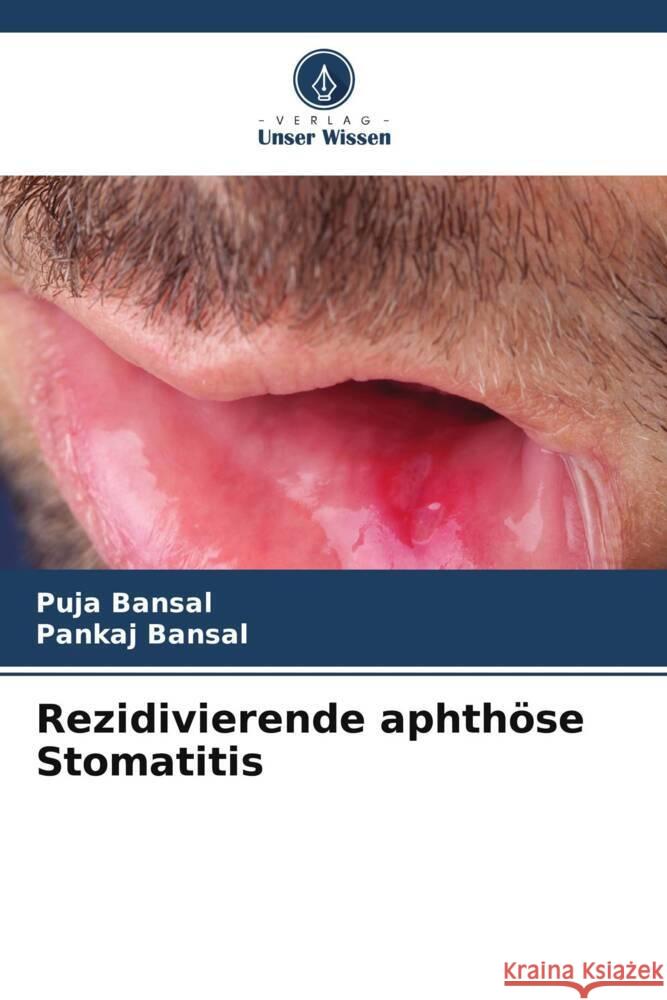 Rezidivierende aphthöse Stomatitis Bansal, Puja, Bansal, Pankaj 9786204785554 Verlag Unser Wissen