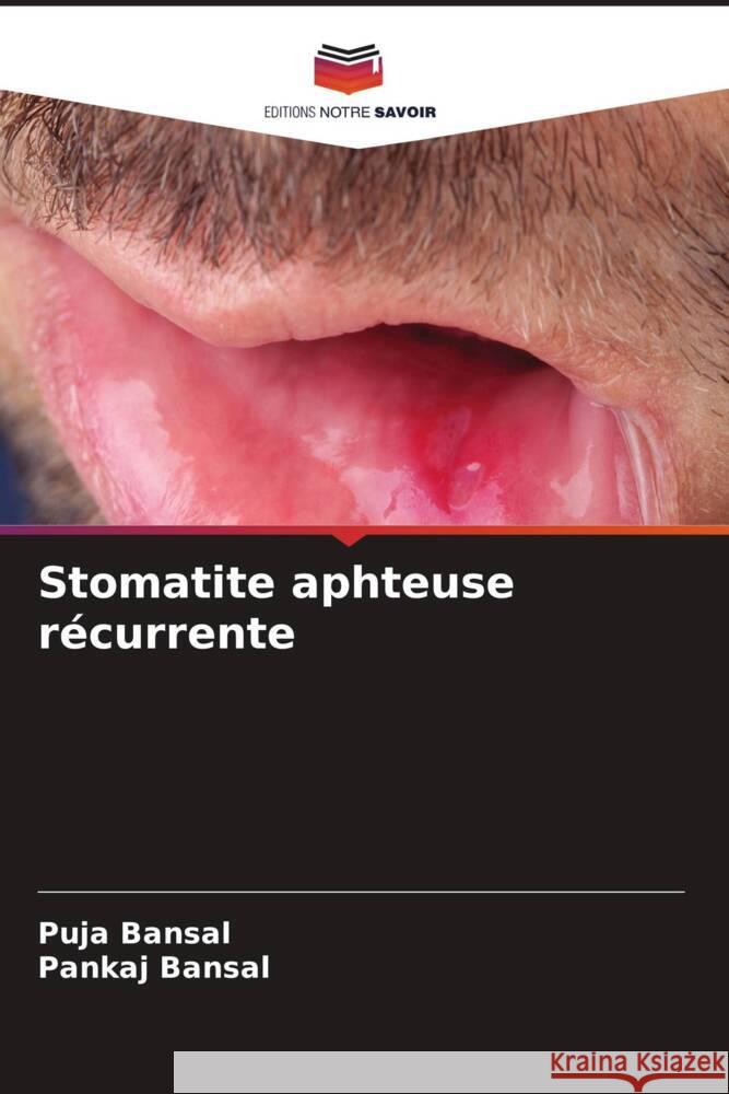 Stomatite aphteuse récurrente Bansal, Puja, Bansal, Pankaj 9786204785578 Editions Notre Savoir