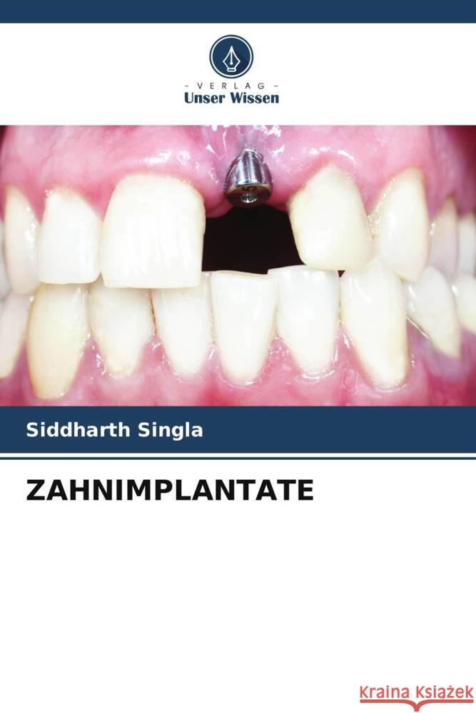 ZAHNIMPLANTATE Singla, Siddharth 9786204793849 Verlag Unser Wissen