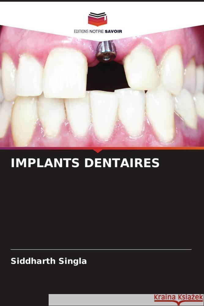 IMPLANTS DENTAIRES Singla, Siddharth 9786204793863 Editions Notre Savoir