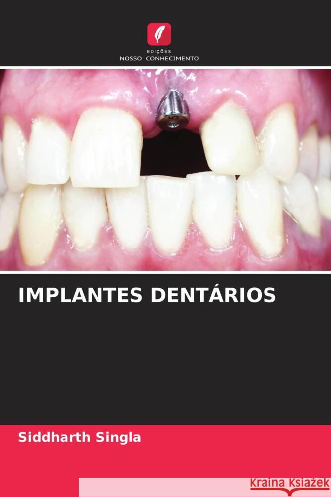 IMPLANTES DENTÁRIOS Singla, Siddharth 9786204803999 Edições Nosso Conhecimento