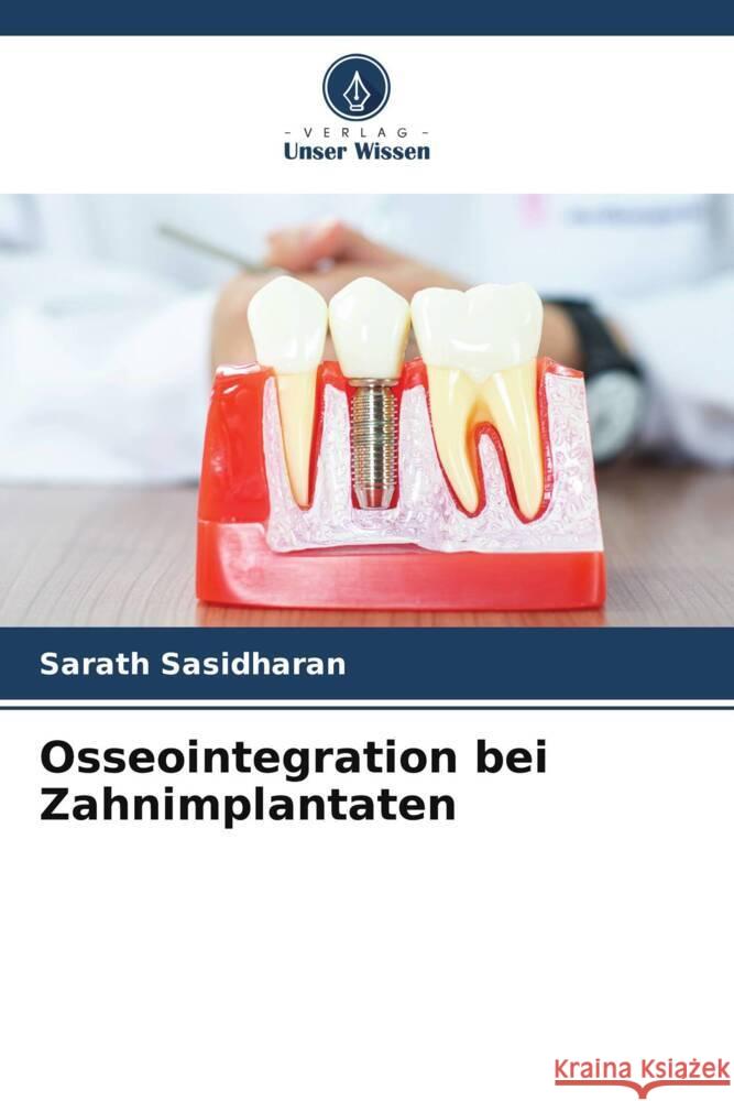 Osseointegration bei Zahnimplantaten Sasidharan, Sarath 9786204809816 Verlag Unser Wissen