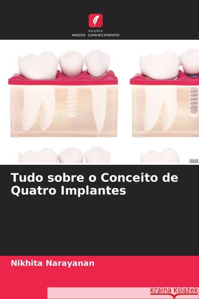 Tudo sobre o Conceito de Quatro Implantes Narayanan, Nikhita 9786204820217