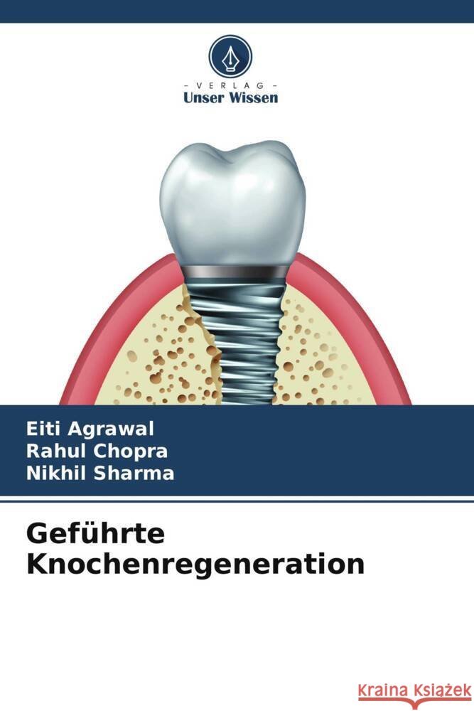 Geführte Knochenregeneration Agrawal, Eiti, Chopra, Rahul, Sharma, Nikhil 9786204820842