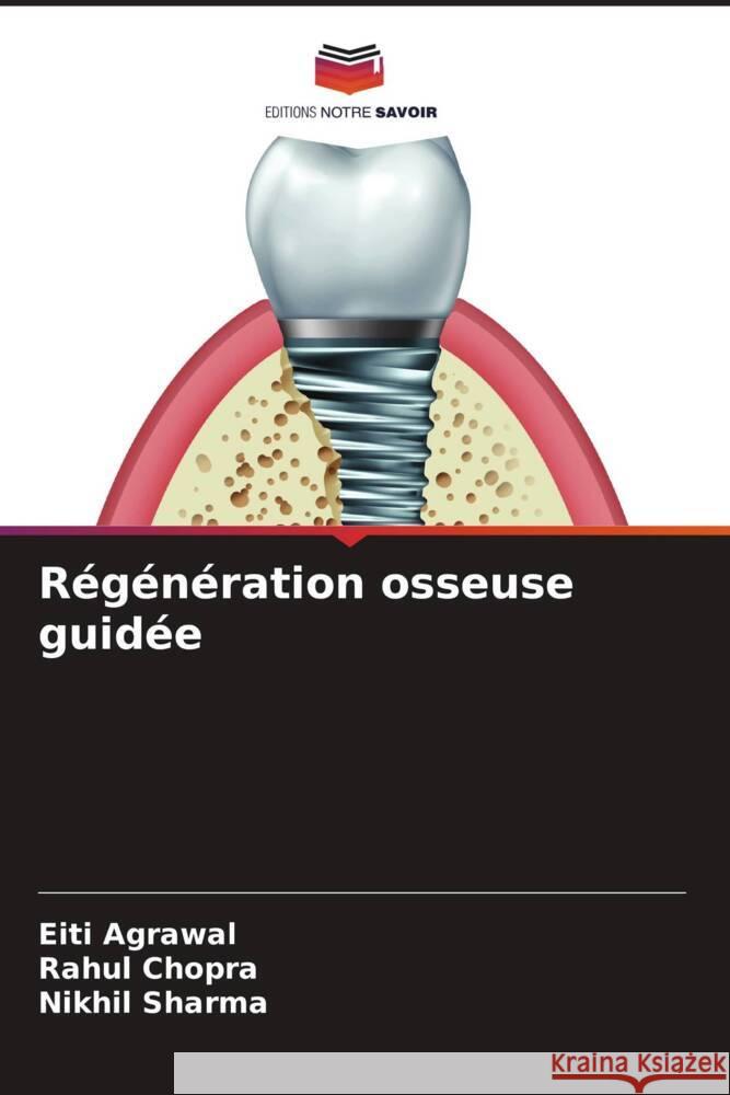 Régénération osseuse guidée Agrawal, Eiti, Chopra, Rahul, Sharma, Nikhil 9786204820866 Editions Notre Savoir