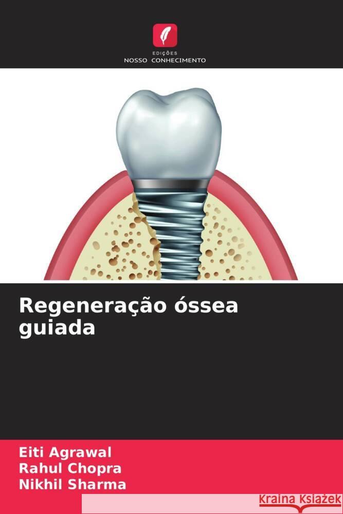 Regeneração óssea guiada Agrawal, Eiti, Chopra, Rahul, Sharma, Nikhil 9786204820873 Edições Nosso Conhecimento