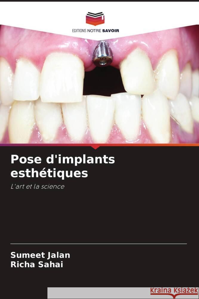 Pose d'implants esthétiques Jalan, Sumeet, Sahai, Richa 9786204844824