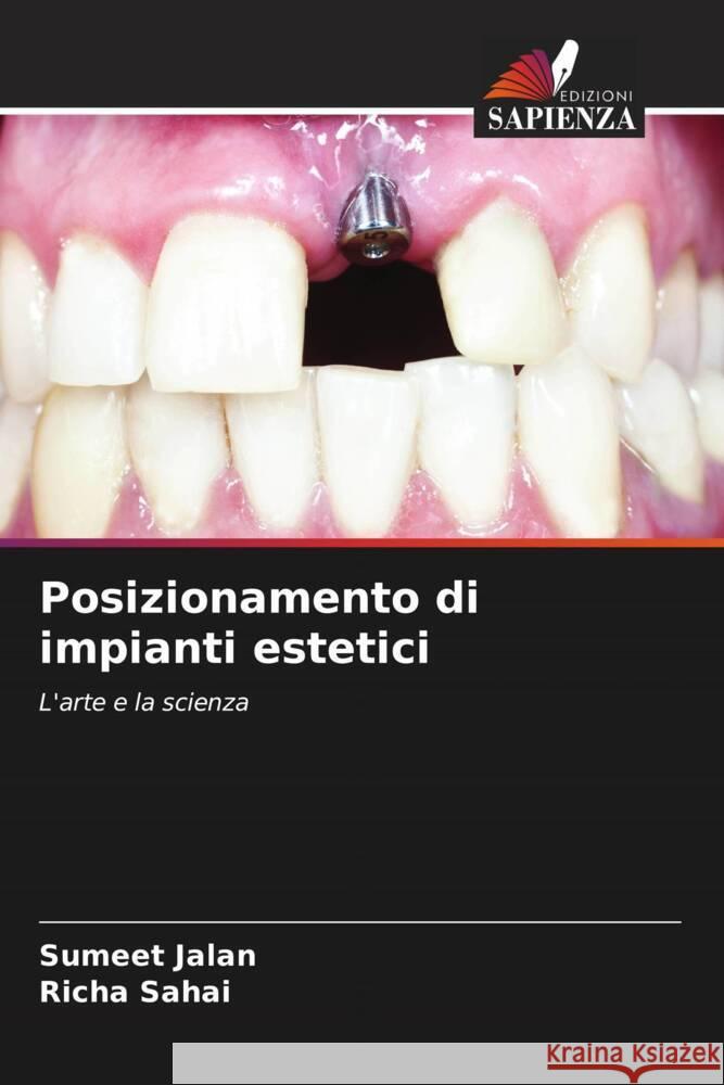 Posizionamento di impianti estetici Jalan, Sumeet, Sahai, Richa 9786204844831