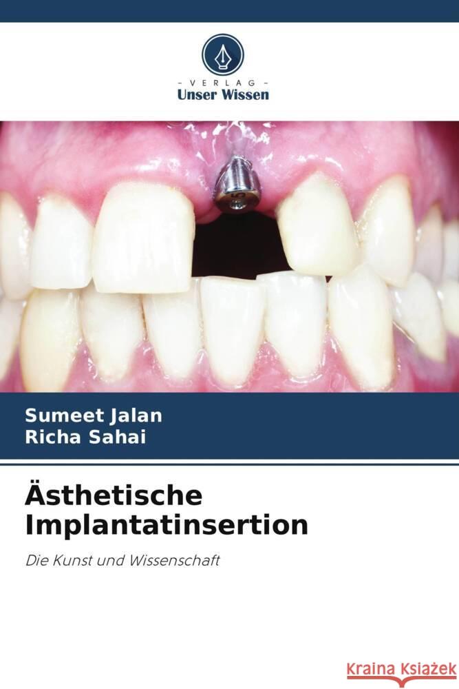 Ästhetische Implantatinsertion Jalan, Sumeet, Sahai, Richa 9786204844886