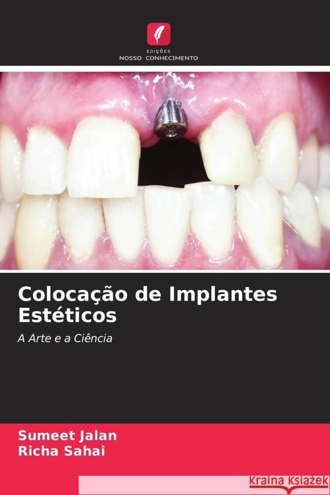 Colocação de Implantes Estéticos Jalan, Sumeet, Sahai, Richa 9786204844893